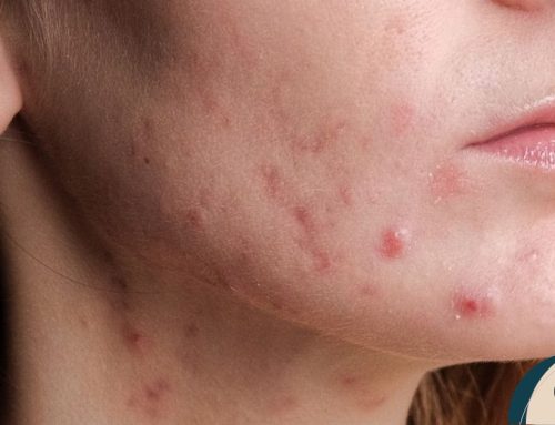 Period breakouts: Το δέρμα σου ξέρει ότι έρχεται περίοδος πριν από εσένα